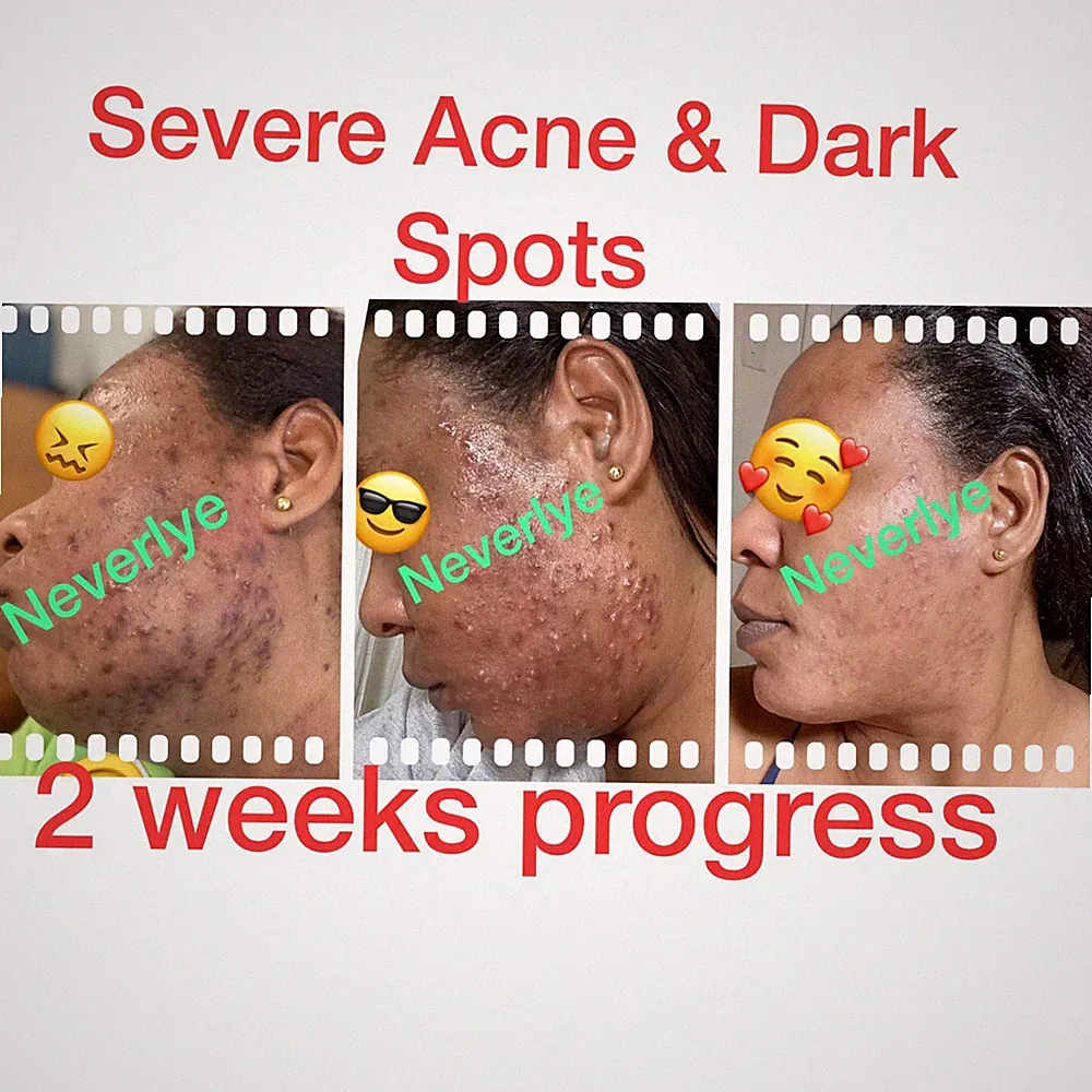 ACNE SOAP: was designed to help treat acne, acne scars, and dark spots.